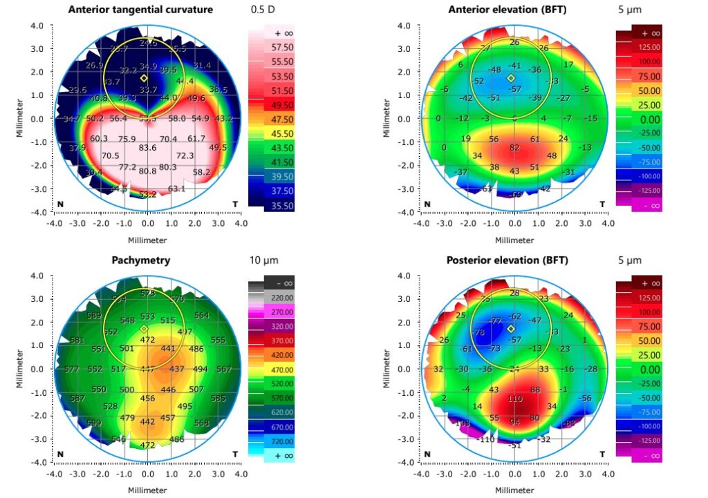 Topografía de un ojo con ectasia corneal irregular preparado para la adaptación de lentes de contacto para queratocono en Gandia.