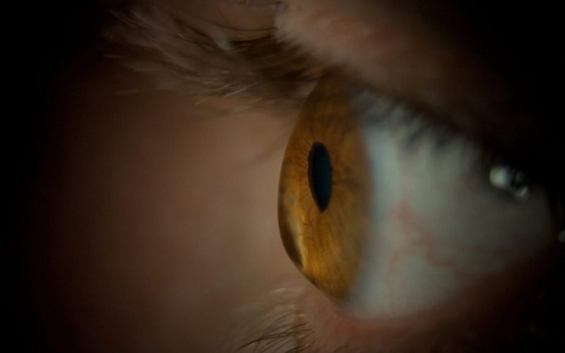 lentillas para queratocono